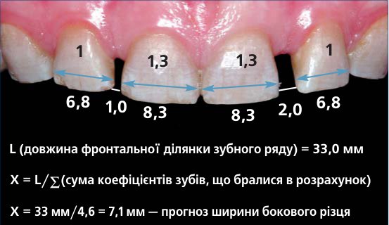 Розрахунок мезіодистальних розмірів різців