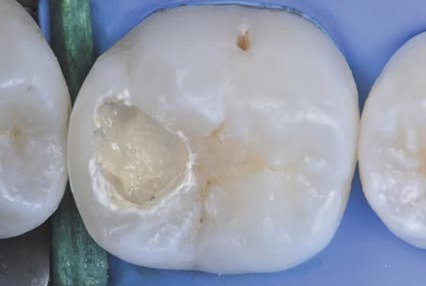 Матеріал Biodentine™ XP нанесено в техніці bio-bulk-fill і делікатно адаптовано пензликом так, щоб достатньо місця залишилося для подальшого нанесення шару композитної емалі.