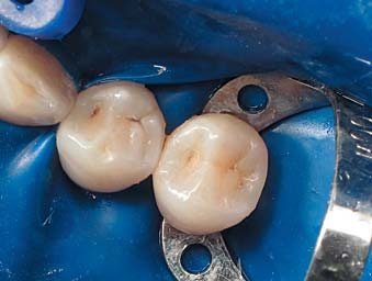 Клінічний випадок 1: адаптація матриці за допомогою флосу, зуб 45.