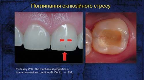 Природний зуб складається з дентину і емалі, що мають різні оптичні властивості