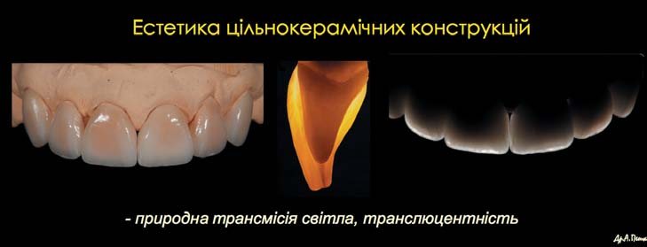 Відбілювання, маскування, естетичні кореневі вкладки