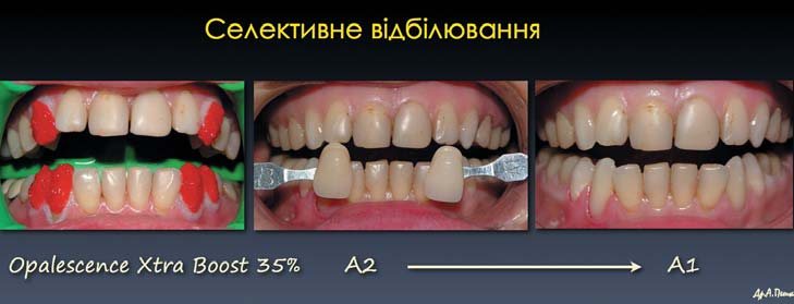 Клінічний випадок: 2006 рік і 2018 рік