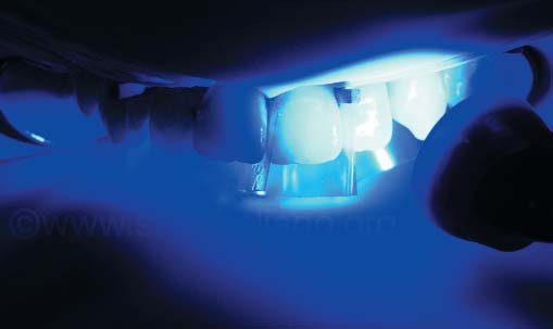 Засвічування смоли протягом не менше 40 секунд (Lampara LED deepcure S, 3M). Ми відокремили зуби один від одного прозорими матричними смужками (Kerr Hawe).