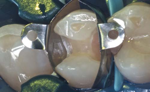 Вузьке кільце Palodent V3 між зубами 13 і 14. Поліпшене прилягання матриці до ясенного краю мезіальної порожнини завдяки додаванню тефлонової стрічки між клином і матрицею (див. також на фото 14).