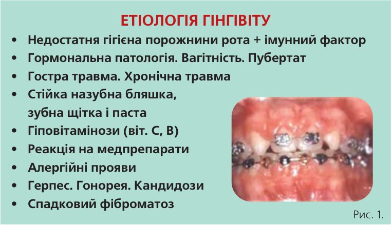Етіологія гінгівіту. Етіологія пародонтиту