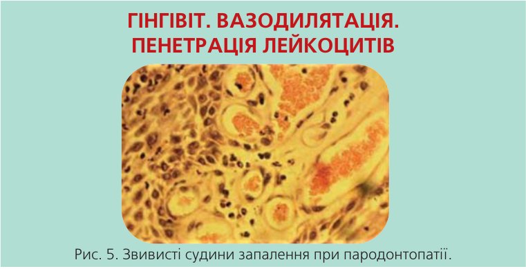 Звивисті судини запалення при пародонтопатії.
